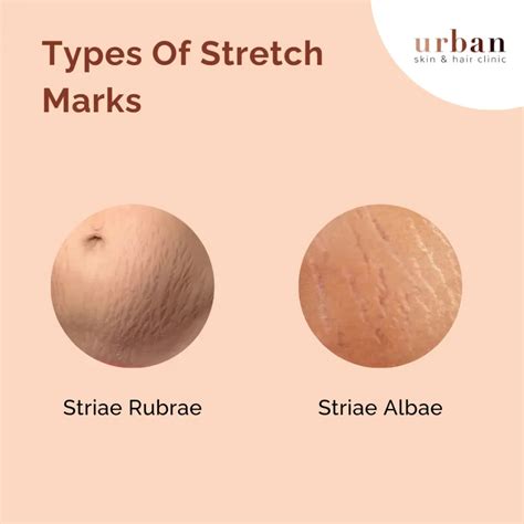 Stretch Marks Types Causes Symptoms And Treatment Ushc