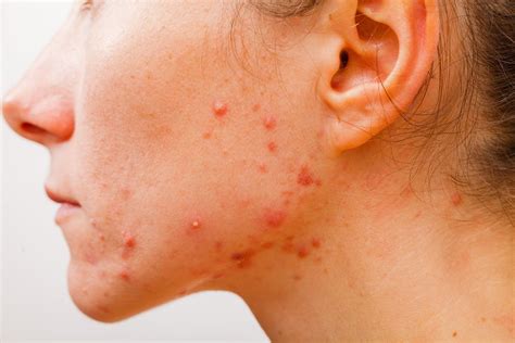 Treatment For Cystic Acne Ways To Get It Treated And Removed