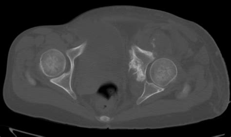 Pelvic Osteosarcoma Ct Sumers Radiology Blog