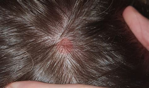 Bump On Scalp About 15cm Across For About A Year Painless What Is