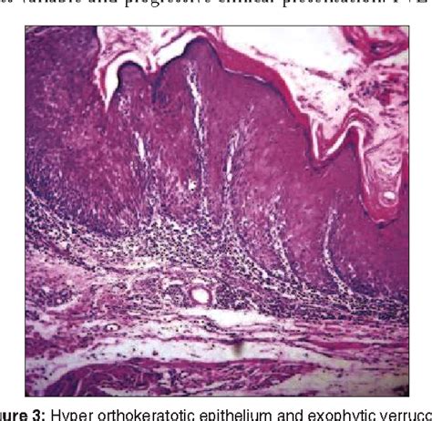 Figure 3 From Proliferative Verrucous Leukoplakia A Case Report With