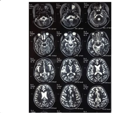 Brain Magnetic Resonance Imaging Sections Showing Generalized Brain