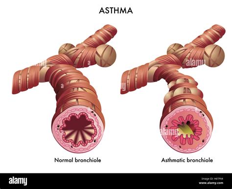 Asma Asma Enfermedad Infecci N Enfermedad Respiratoria Enfermedad Inhalador Pecho Bronquiolitis