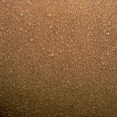 If You See One Of These 13 Bumps On Your Skin Do Not Pop Keratosis