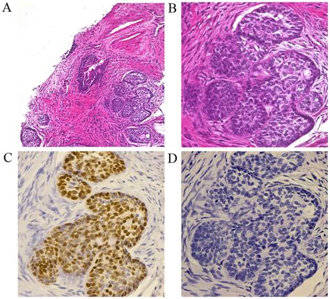 Basal Cell Carcinoma Of The Prostate A Case Report And Review Of The