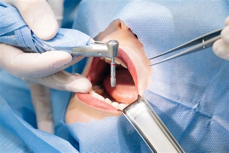 Tips To Get Ready For Dental Implant Surgery Torrey Hills Periodontal Group Periodontist San