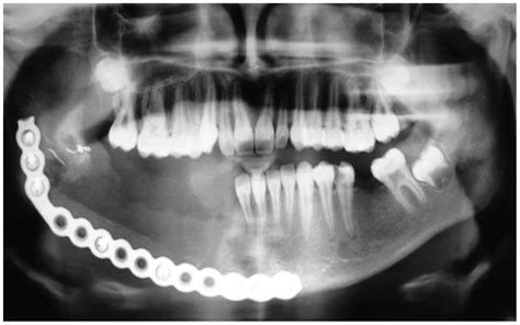Benign Osteoblastoma Of The Mandible In A 12‑year‑old Female A Case Report