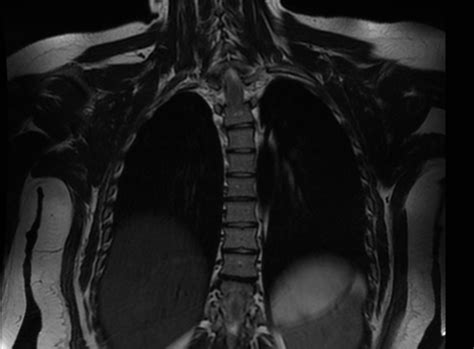 Osteoid Osteoma Spine Image