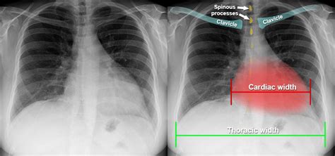 Chest X Ray Pa View Showing Cardiomegaly With Left Ve