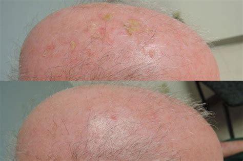 Topical Treatment Clears Precancerous Skin Lesions Harvard Gazette