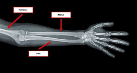 Bones In The Arm Joi Jacksonville Orthopaedic Institute