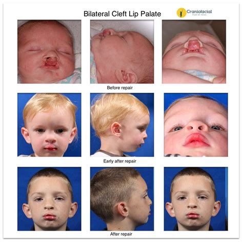 Albums Images Cleft Palate Before And After Surgery Photos Stunning