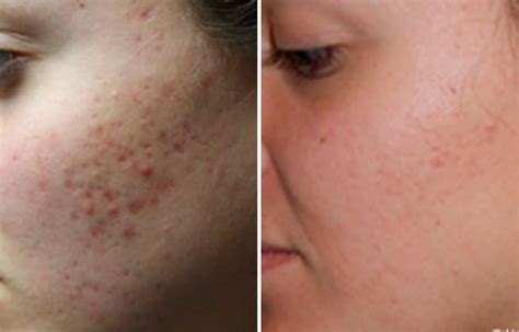 Acne Scars Removal