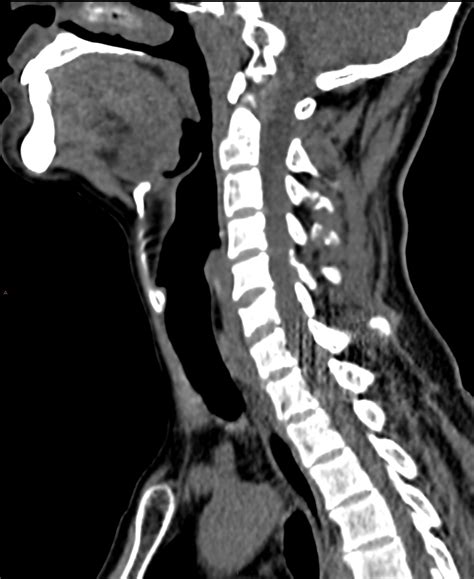 C6 Compression Fracture With Posterior Spinal Fractures And Cord