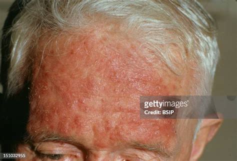 Acne Rosacea Photos And Premium High Res Pictures Getty Images