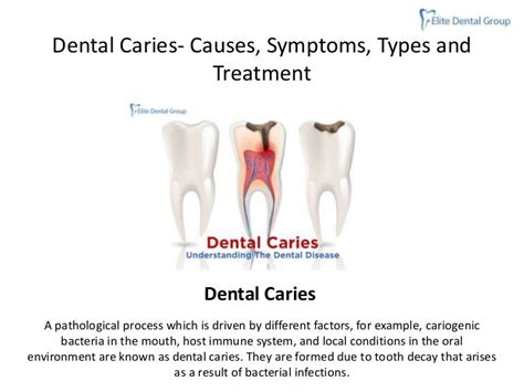 Dental Caries Causes Symptoms Types Treatment