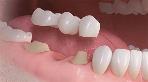 Preguntas De Tus Pacientes Sobre Puentes Coronas Y Carillas Dentales
