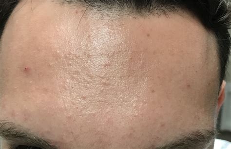 Small Bumps All Over Forehead Folliculitis General Acne