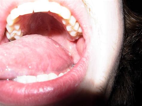 Glandular Fever On My Tongue Flickr Photo Sharing