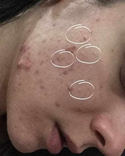 Does Tretinoin Help With Closed Comedones