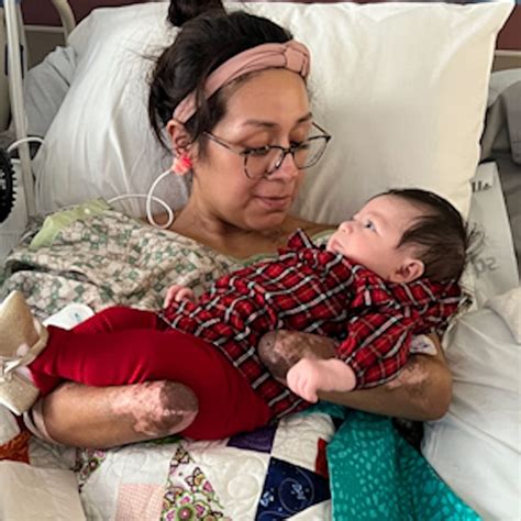 Mom Has Hands Feet Amputated After Going Into Septic Shock After Giving Birth Good Morning