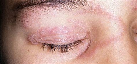 Псориаз на лице причины симптомы и лечение кожи