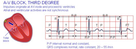 The picture above will help illustrate to you what i am talking about. 4.C Third-degree atrioventricular block. | Download ...