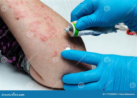 A Dermatologist In Gloves Applies A Therapeutic Ointment To The