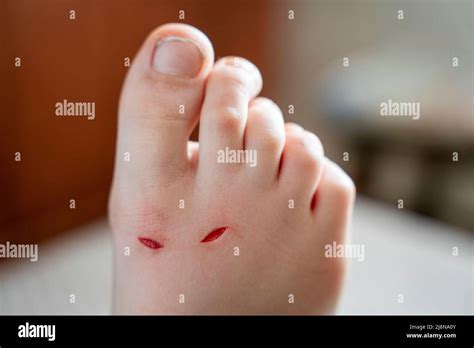 Healing Of Bleeding Wounds On A Childs Leg From Cuts Stock Photo Alamy