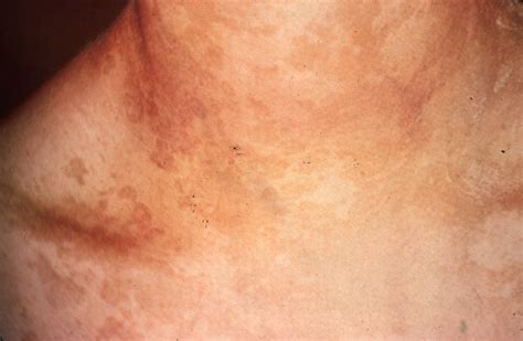 Pityriasis Versicolor Pityriasis Versicolor