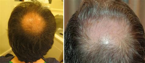 Bald Spot On Crown How To Spot It And How To Stop It