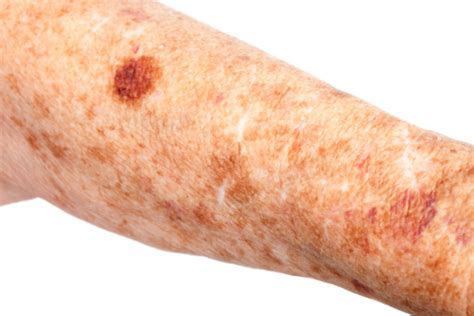 Medical Liver Spots And Hematoma Stock Photo Download Image Now Istock