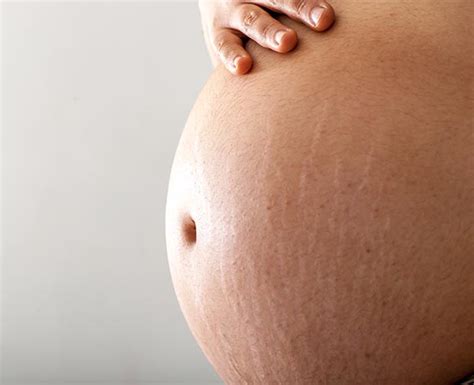 Stretch Marks In Pregnancy What Women Need To Know