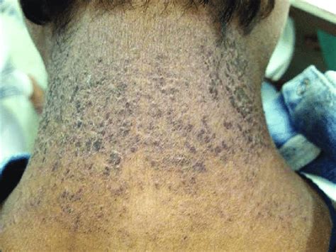 Multiple Scaly Pigmented Patches On The Nape Of Neck Download