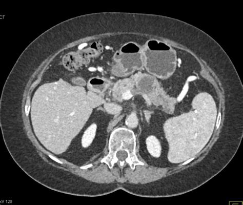 Location Of Your Pancreas