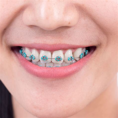 Types Of Dental Retainers To Wear After Braces Clear Retainers Near Me Teeth Straightening