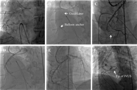 A Selective Right Coronary Artery Angiography By Tip In Open I