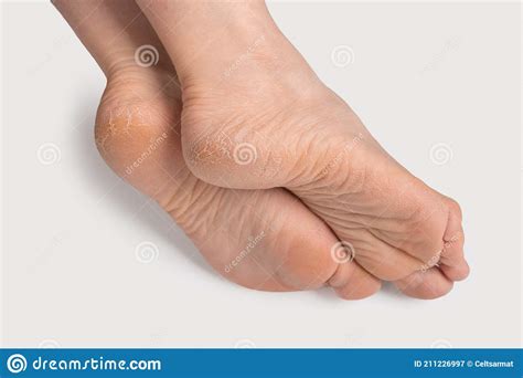 Dry And Cracked Soles Of Feet Female Legs Feet Foot In An Elegant
