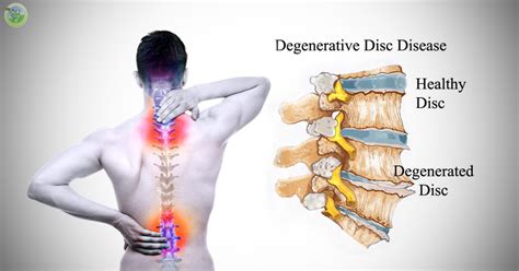 Why fragmentation is to be kept in check? What Is Degenerative Disc Disease? - Orthopedic & Sports ...
