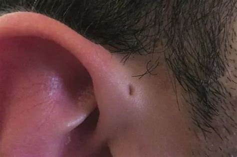Some People Are Born With Tiny Holes Above Their Ears Heres Why