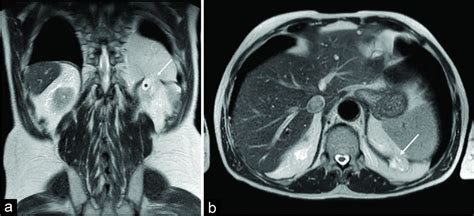 Magnetic Resonance Imaging Of The Diaphragm From Normal To Pathologic