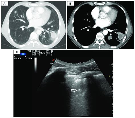 A Axial Chest Computed Tomography Ct Pulmonary Window Showing A Download Scientific