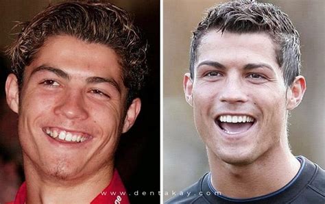 Ronaldo S Teeth And Smile Makeover Dentakay