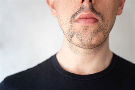 Why Beard Hair Loss Happens And How To Treat It Readers Digest