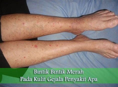 Untungnya, ada beberapa cara mudah untuk mengatasi dan mencegah timbulnya ruam pada bayi dan anak. Bintik bintik merah pada kulit gejala penyakit apa? Bisa ...