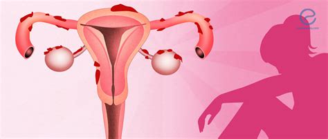 Learn about treatment, causes, stages, surgery, and diagnosis. Overview of NICE Endometriosis Guidelines | EndoNews
