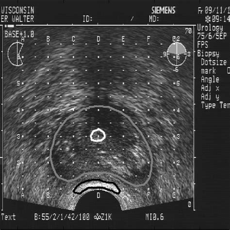 Transrectal Ultrasound Image Of The Prostate With The Regions Of