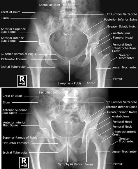 Male Versus Female Pelvis Labeled Radiographic Anatomy Pelvis