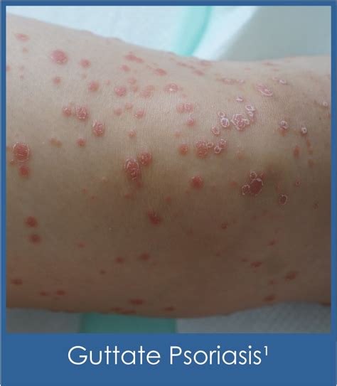 Understanding Psoriatic Disease Houston Dermatology Specialists