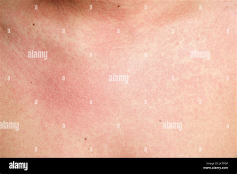 Itchy Skin Rash Hi Res Stock Photography And Images Alamy